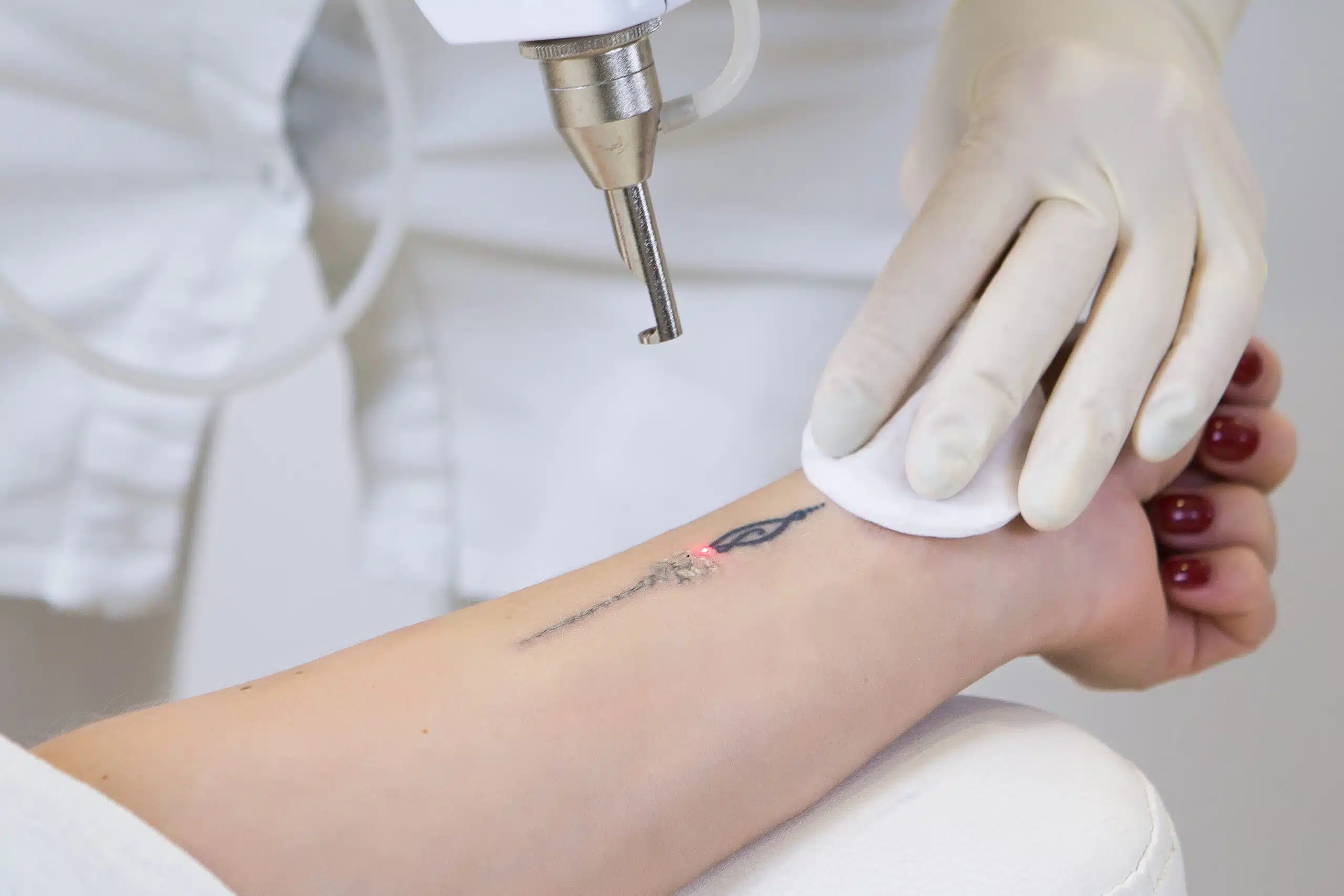 séance de détatouage laser