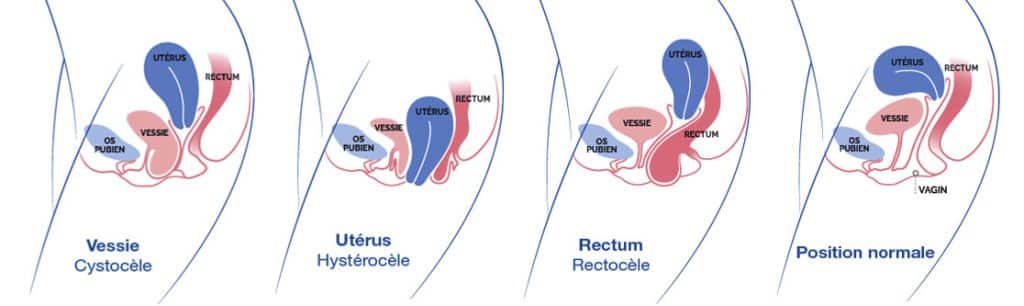 Qu’est-ce qu’un prolapsus génital ?