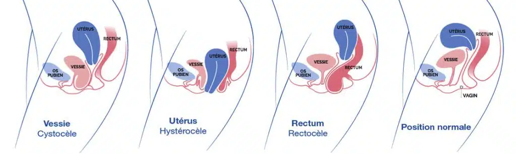 Qu’est-ce qu’un prolapsus génital ?