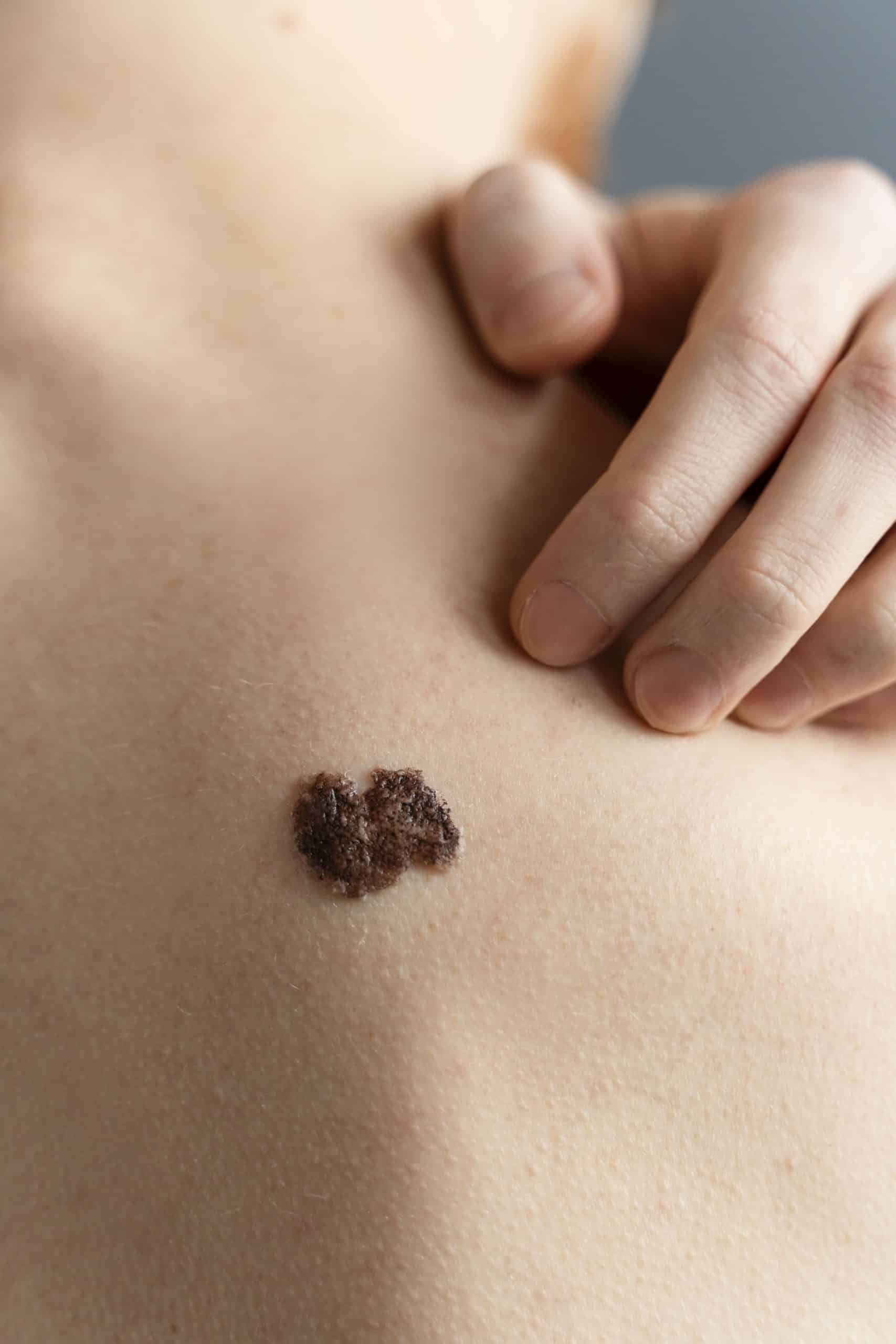 Molluscum ou verrue : comment faire la différence ?