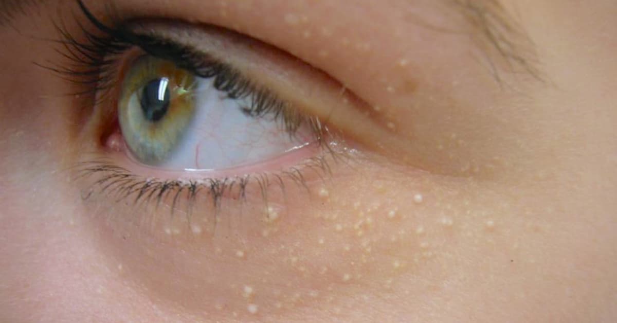 Petites bosses sur la peau : comment les reconnaître